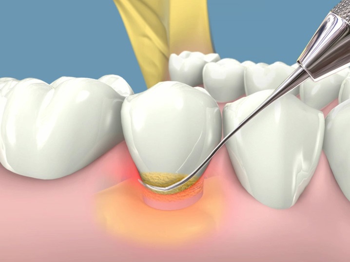 Enfermedad en las encías: gingivitis  y periodontitis